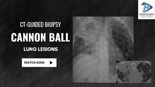 Cannon Ball Lung Lesions CT guided biopsy#Preetam.P #Dr.Umamaheswara Reddy.V