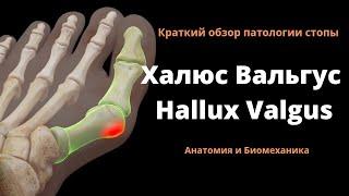 Халюс Вальгус. Hallux Valgus. 3D анатомия.