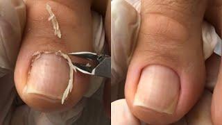 Removendo cutícula do dedão do pé