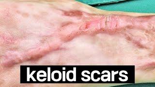 Burn scar treatment that failed steroid treatment and evolved into keloid Part 2