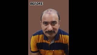 FUE Hair Transplant  Best Hair Transplant In Pakistan  Zunair Aesthetics