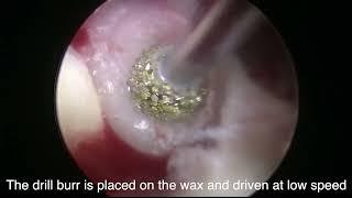Asvide Handling of bone wax applicator under the endoscope.