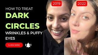 How to treat dark circles under eye wrinkles puffy eyes and hallow under eyes