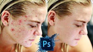 How to remove pimples in Photoshop 2022