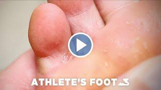 How To Treat Athletes Foot - BioPed Footcare