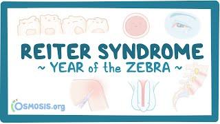 Reiter syndrome Year of the Zebra