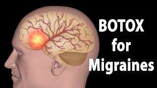 BOTOX for Migraines Animation.