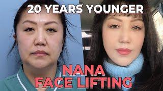 SUB Anti-Aging  Face Lift and Neck Lift Surgery  Before After Recovery in Korea Plastic Surgery