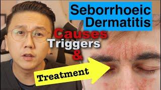 Seborrhoeic Dermatitis - Causes Triggers & Treatment Options