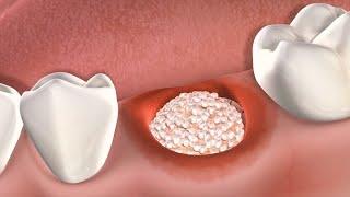 Ghép xương cấy răng implant  Implant bone graft