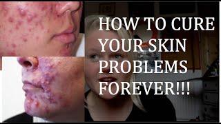 How to cure acne and spots WITHOUT pills or medicine