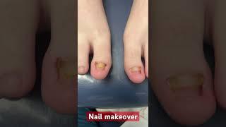 Toenail summer makeover #uglytobeautiful #toenailfungus