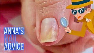 Nail Separation  Causes  Early Treatment of Onycholysis Annas Nail Advice