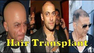 Top Bollywood Actors Went Through Hair Transplant  You Wont Believe