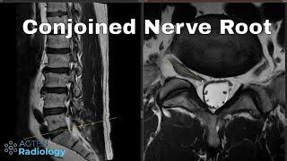 How to detect conjoined lumbosacral nerve roots on MRI