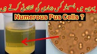 Numerous Pus Cells In Urine Urduhindi What causes numerous pus cells in urine? Numerous Leukocytes