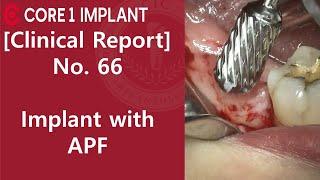 CYBERMED Clinical Report #47 Implant placement with APF