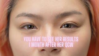 You have to see her results 1 month after her #QCW - Eyelid Procedure