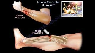 Types & Mechanism Of Fractures  - Everything You Need To Know - Dr. Nabil Ebraheim