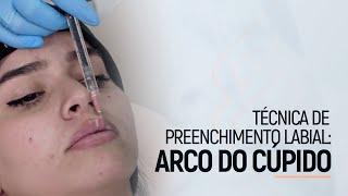 Técnica de Preenchimento Labial Arco do Cupido  Dra. Bruna Almeida