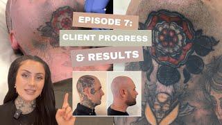 Laser Tattoo Removal Client Progress & Results