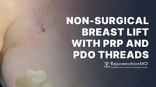 Beautiful Non-Surgical Breast Enhancement  PRP and PDO Thread Breast Lift