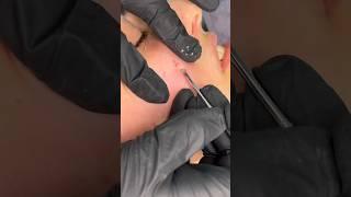 Blackhead removal جوش زیر پوستی؟