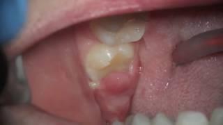 whats this sore gum on wisdom tooth - pericoronitis