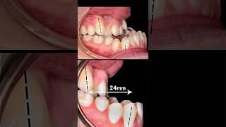 Underbite so much #braces #orthodontist #dentist