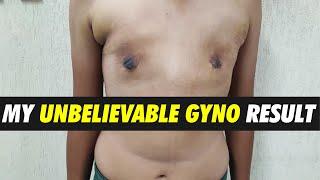 Teenage Gynecomastia Surgery Result After 5 days