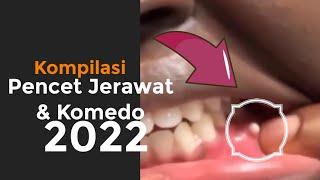 Kompilasi Pencet Jerawat dan Komedo Terbaru 2022