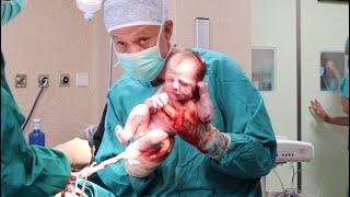  Live #caesarean birth of twins. Watch the father’s face 