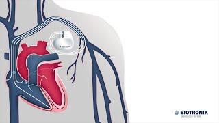 Cardiac Resynchronization Therapy - Sådan virker det