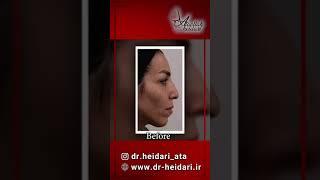 Facial fat transfer real video  فیلم واقعی تزریق چربی به صورت