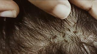 #Asmr picking big lice 