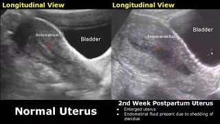 Gynecological & Obstetric Ultrasound Normal Vs Abnormal Scan  Uterus Ovary Cervix Pregnancy USG