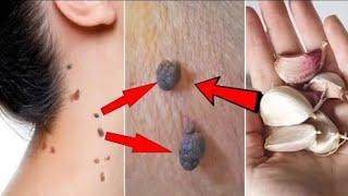 Remove skin tags in 1 night  Amazing Skin Tag Removal Remedies  How to remove skin tags.