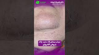 الکترولیزر موهای زائد سفید چانه دکتر میمند لیزر موهای زائد کرج #لیزرpdl #laserhairremoval