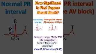 How Significant is First Degree Heart Block?