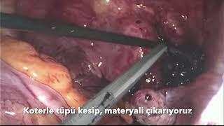 Laparoskopik ektopik gebelik dış gebelik operasyonu