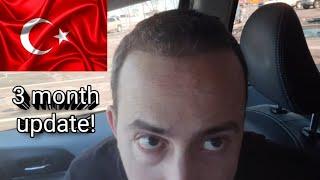  Turkey Hair Transplant 3 month Update