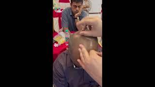 Fire on the mountain- Scalp Acupuncture - Bangalore seminar