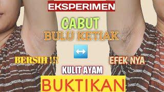 MENCABUT BULU KETIAK VS KULIT AYAM  HOW INGROWNS ARE REMOVED • BERDARAH INI EFEK NYA