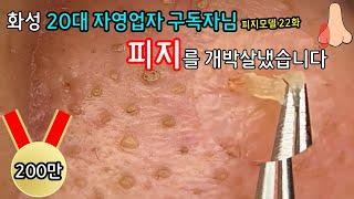 피지 직접 뽑아드렸습니다 _ 피지제거 블랙헤드제거 피지뽑기 _  22번째 모델이신 화성 자영업자 대표 20대 남자분의 피지를 박살냈습니다