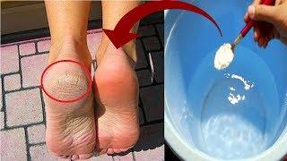 In Just 3 Minutes - Get Rid of CRACKED HEELS Permanently Magical Cracked Heels Home Remedy