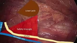 Asvide Narrated hand-assisted left laparoscopic nephrectomy for kidney transplant.