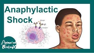 Anaphylactic shock  Anaphylactic Reaction Symptoms and Treatment