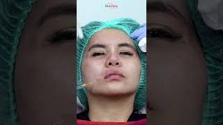 INI DIA BAGIAN PADA WAJAH YANG DI FILLER   #Filler #fillerhidung #fillerdagu