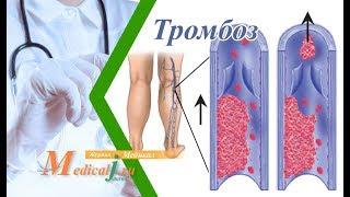 Тромбоз глубоких вен ног. Причины симптомы и лечение