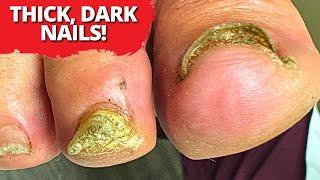 Cutting Thick Darkened Nails On Incredibly Swollen Legs